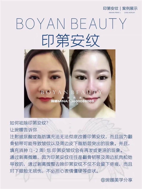 剥离微雕