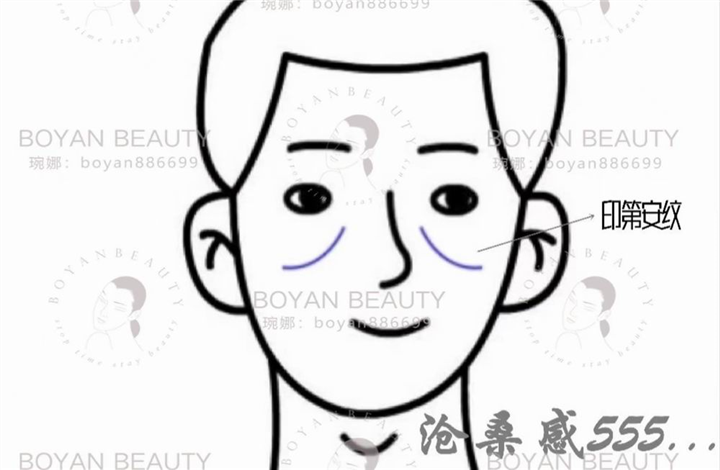 印第安纹剥离有用没