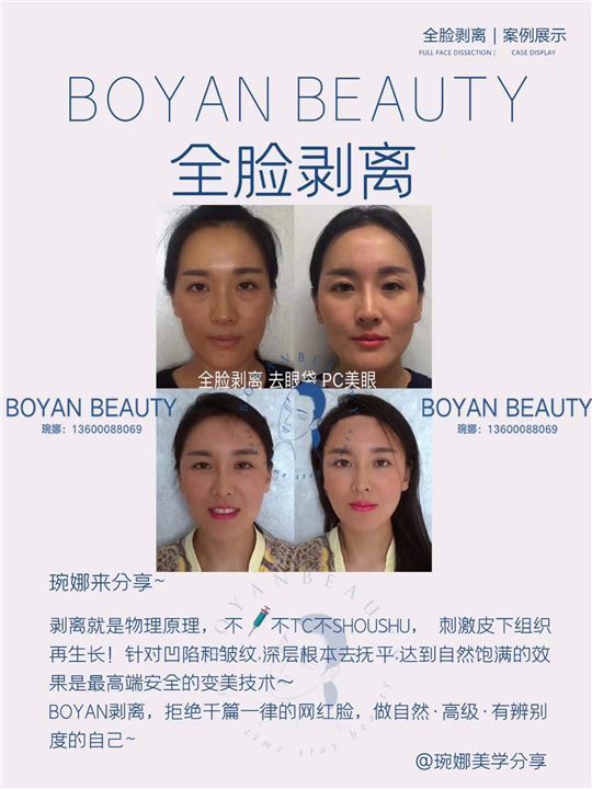 全脸剥离