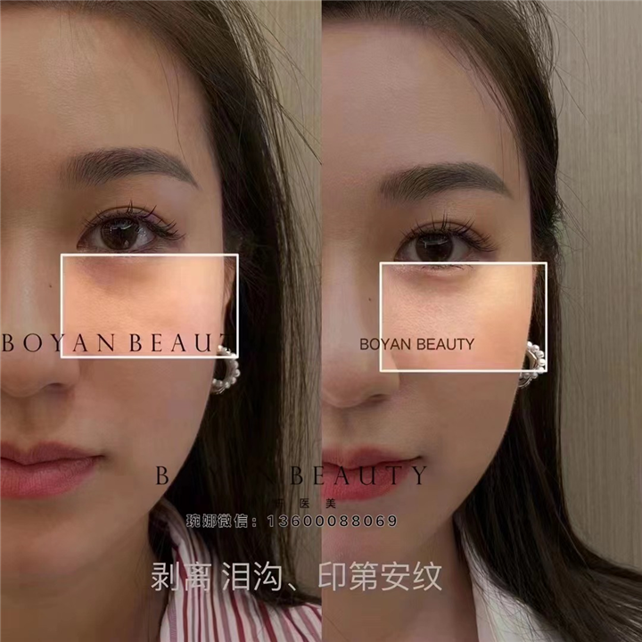 印第安纹怎么去除效果好