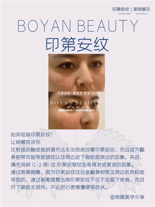 剥离微雕