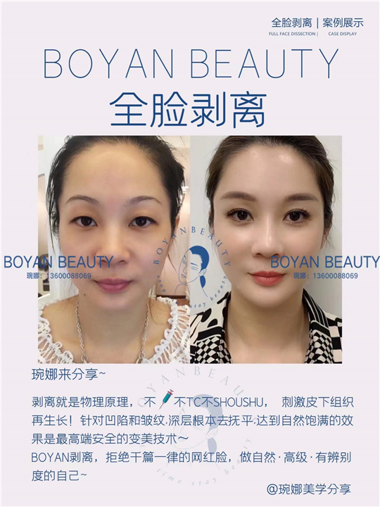 全脸剥离