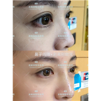 北京剥离微整|剥离微整北京能做吗