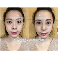 北京剥离微整|剥离微整北京能做吗