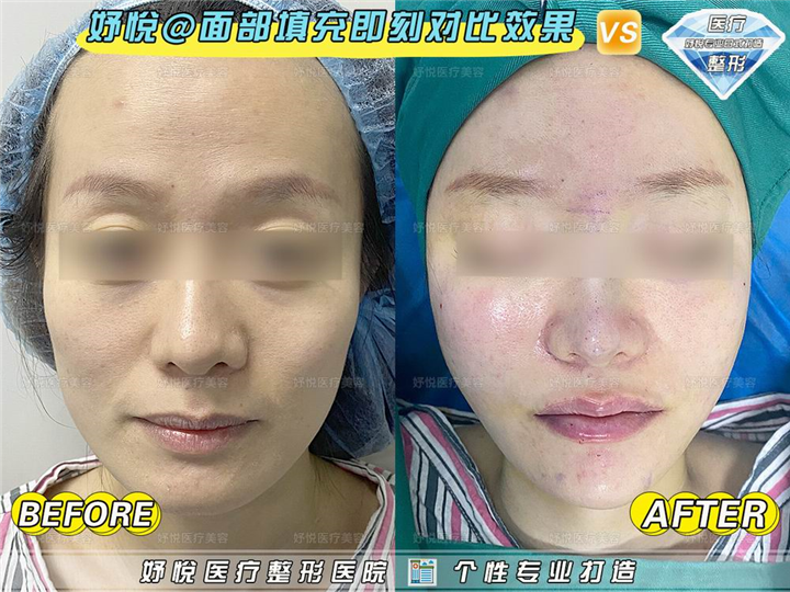 妤悦整形眼综合