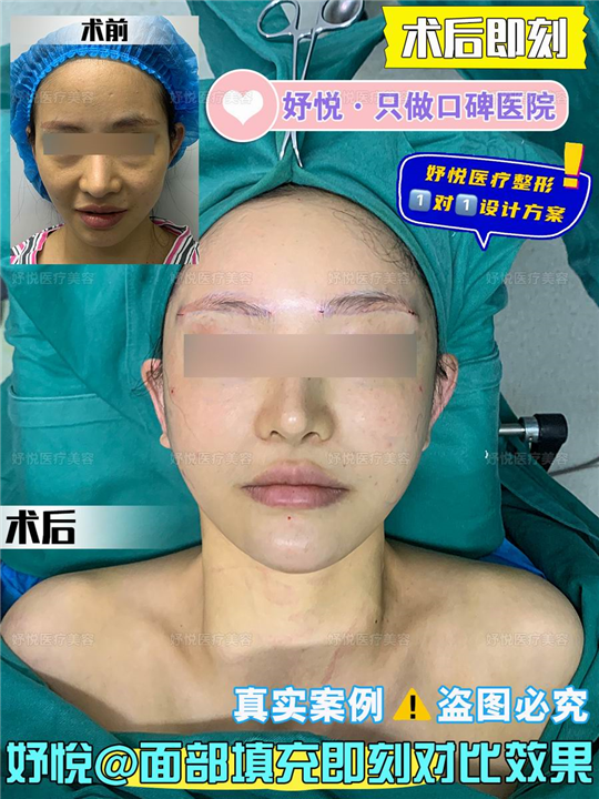 妤悦整形眼综合