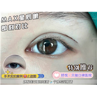 妤悦整形眼综合