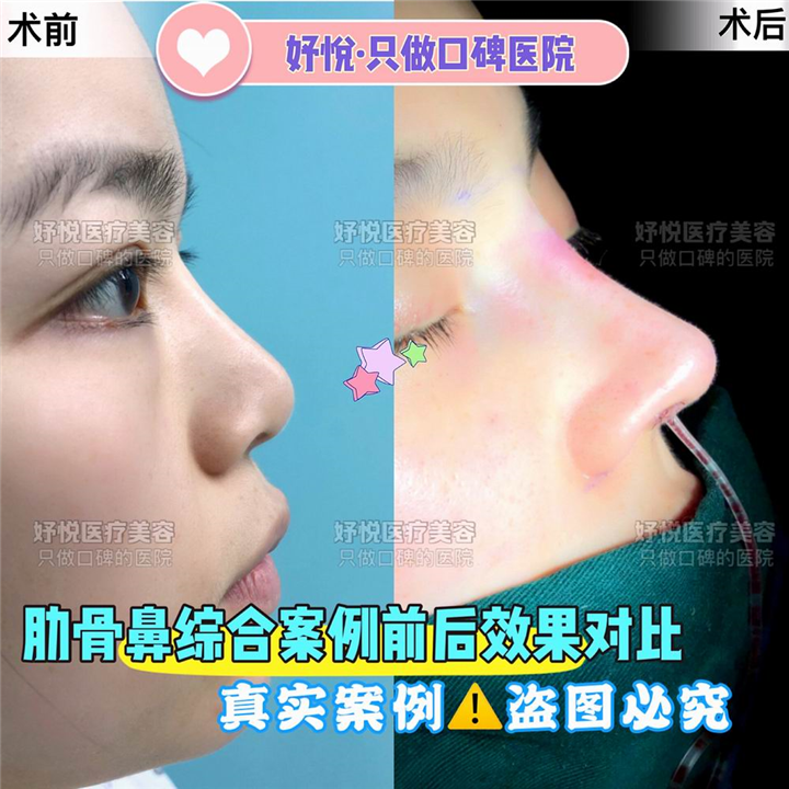 妤悦整形眼综合