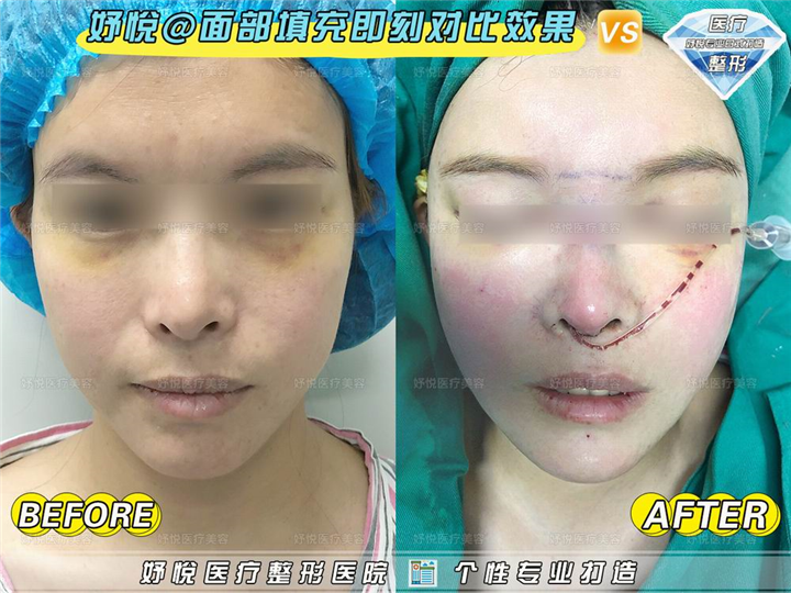 妤悦整形眼综合