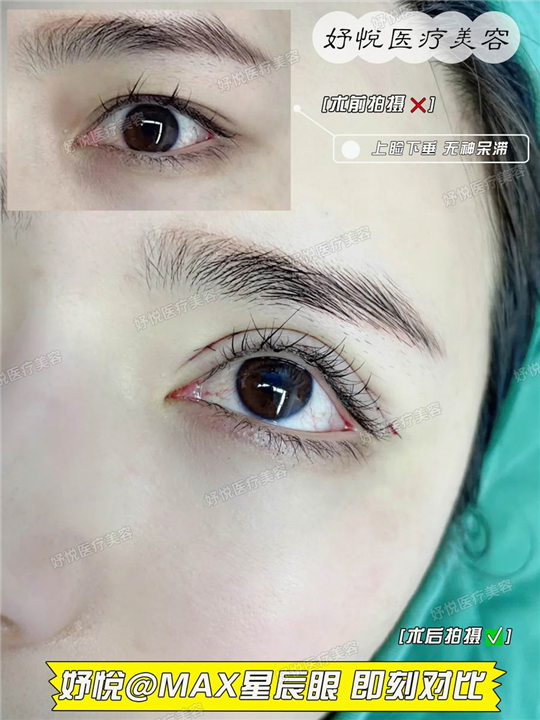 妤悦整形眼综合