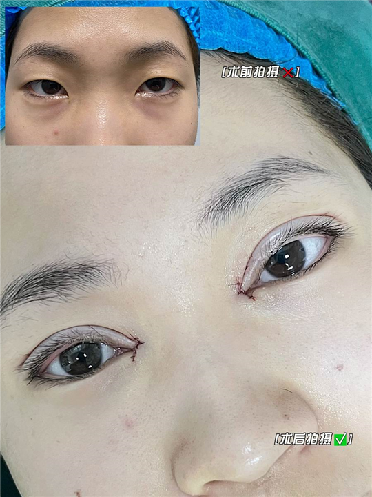 妤悦整形眼综合