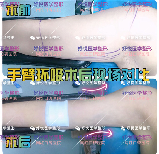 妤悦整形吸脂瘦身