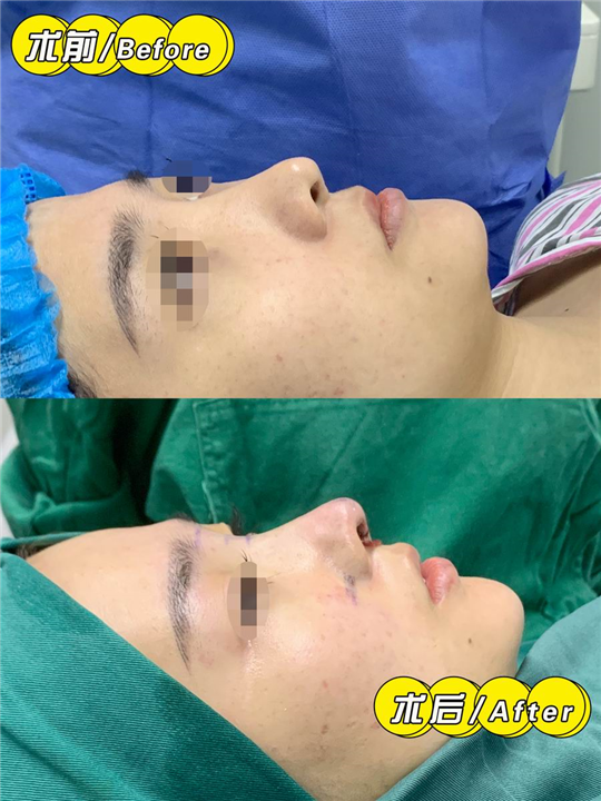 妤悦整形丰胸案例