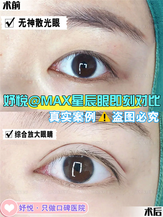 妤悦整形眼综合