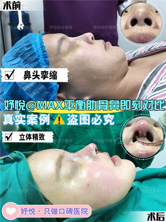 妤悦整形丰胸案例