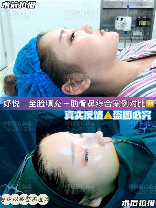 妤悦整形鼻综合