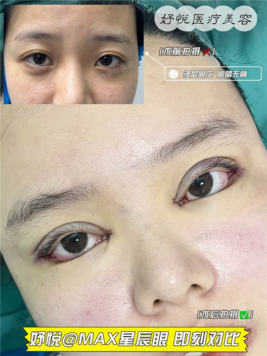 妤悦整形眼综合