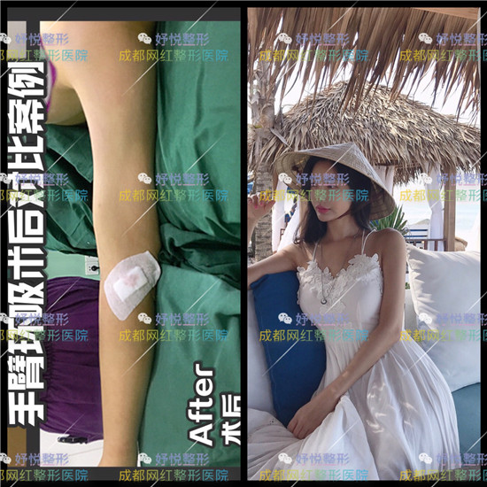 妤悦整形吸脂瘦身