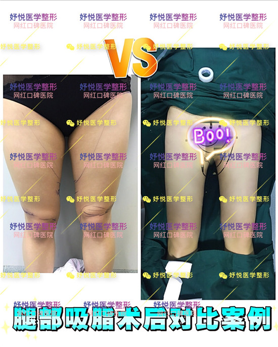 妤悦整形吸脂瘦身