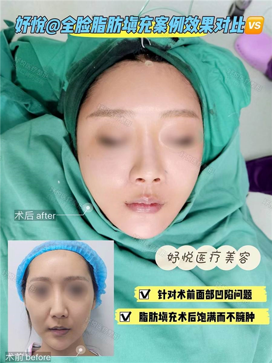 妤悦整形鼻综合