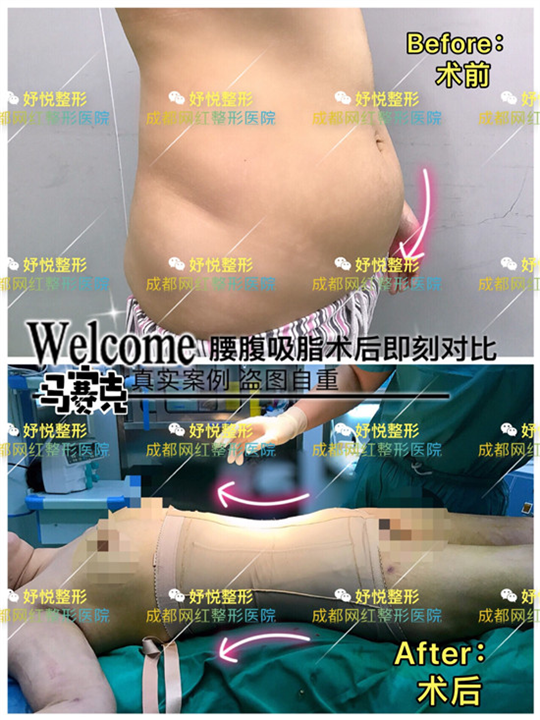 妤悦整形吸脂瘦身