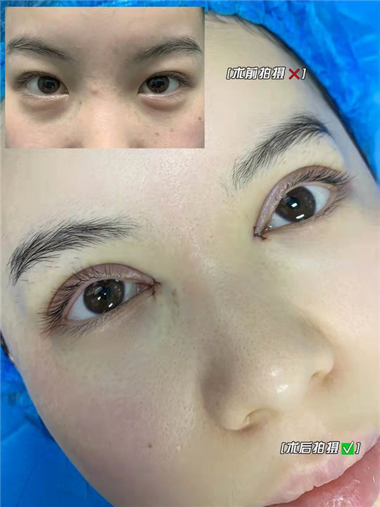 妤悦整形眼综合