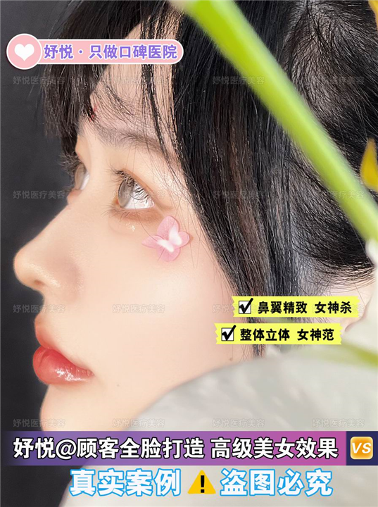 妤悦整形丰胸案例