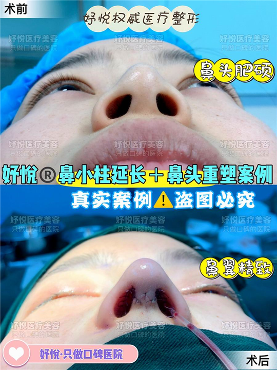 妤悦整形眼综合