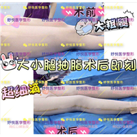 妤悦整形吸脂瘦身