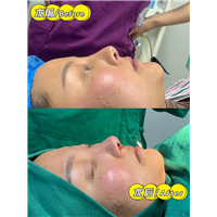 妤悦整形丰胸案例