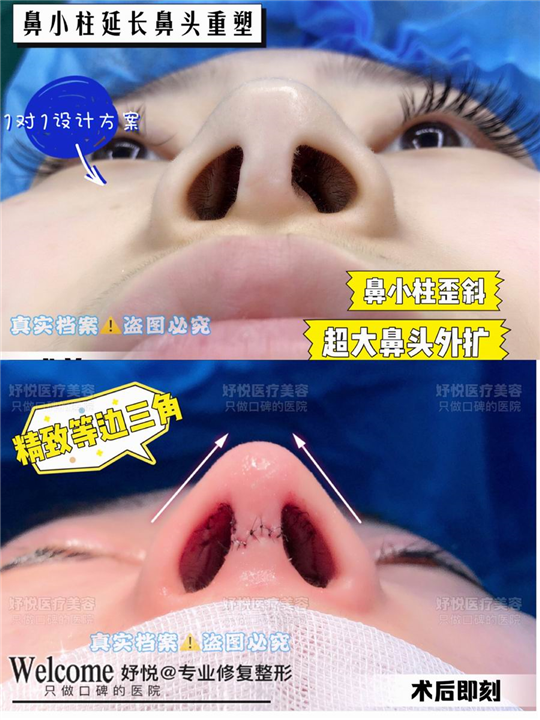 妤悦整形眼综合