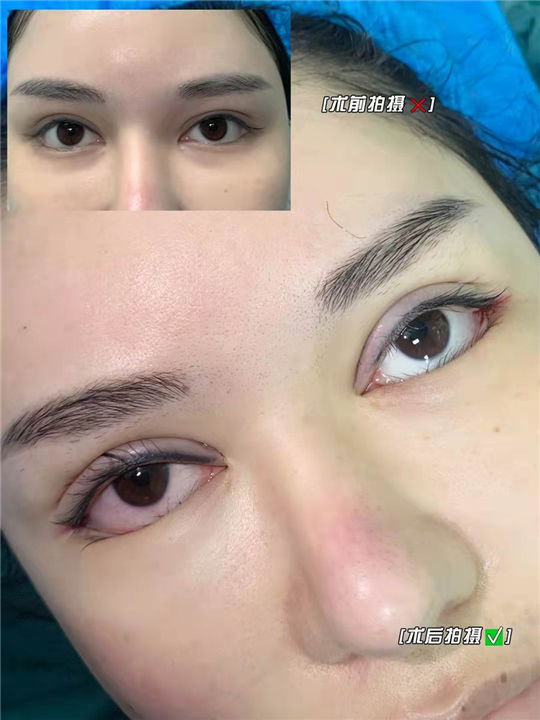 妤悦整形眼综合