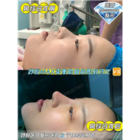 妤悦整形丰胸案例