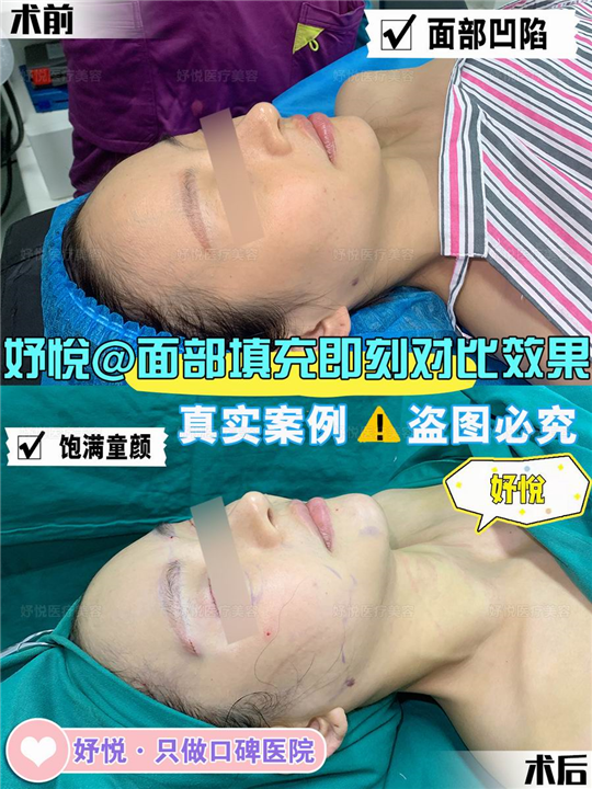 妤悦整形眼综合