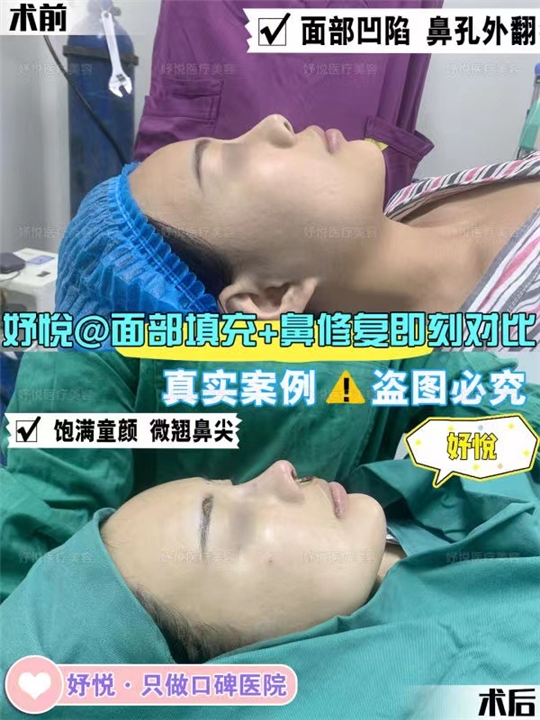 妤悦整形丰胸案例