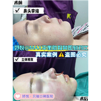 妤悦整形丰胸案例