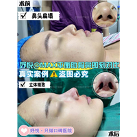 妤悦整形丰胸案例