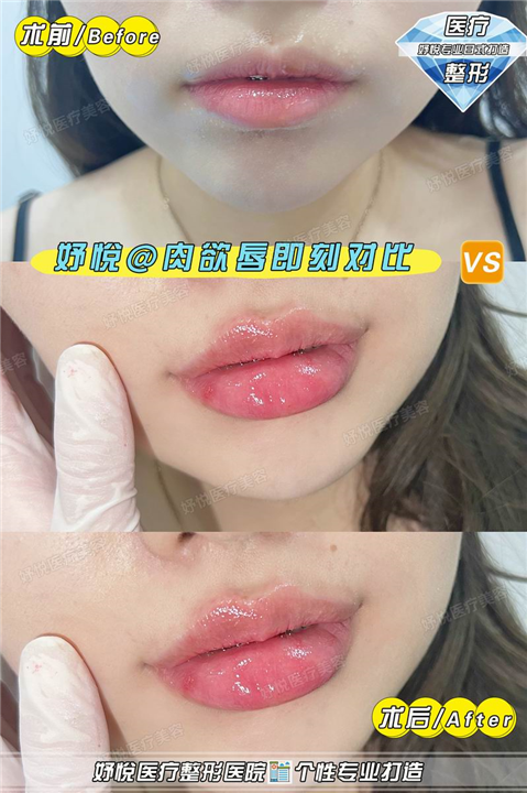 妤悦整形鼻综合