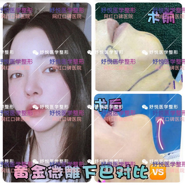 成都网红整形|成都鼻综合整形