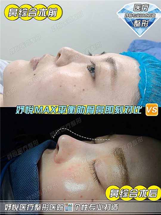 妤悦整形丰胸案例