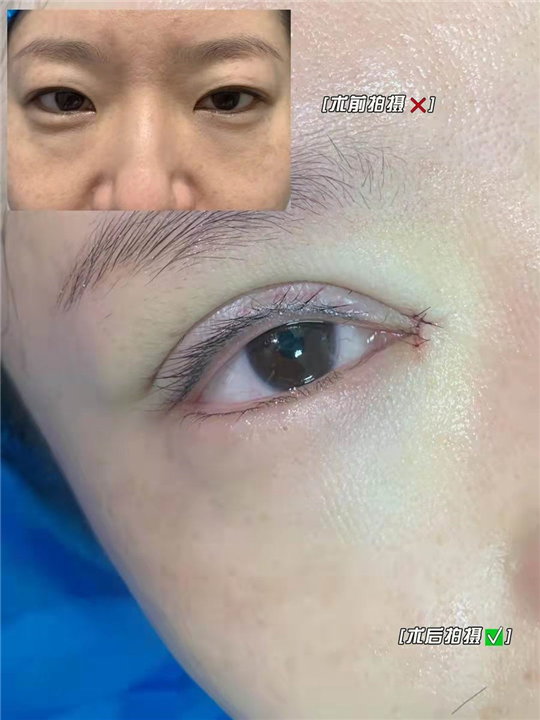 妤悦整形眼综合
