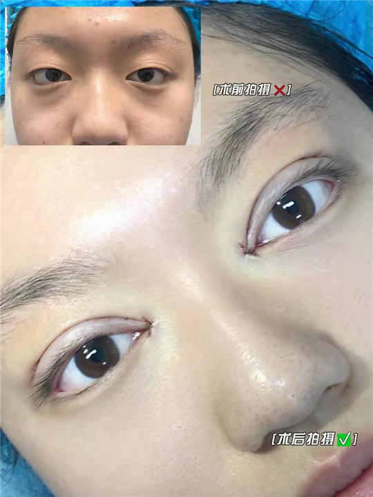 妤悦整形眼综合