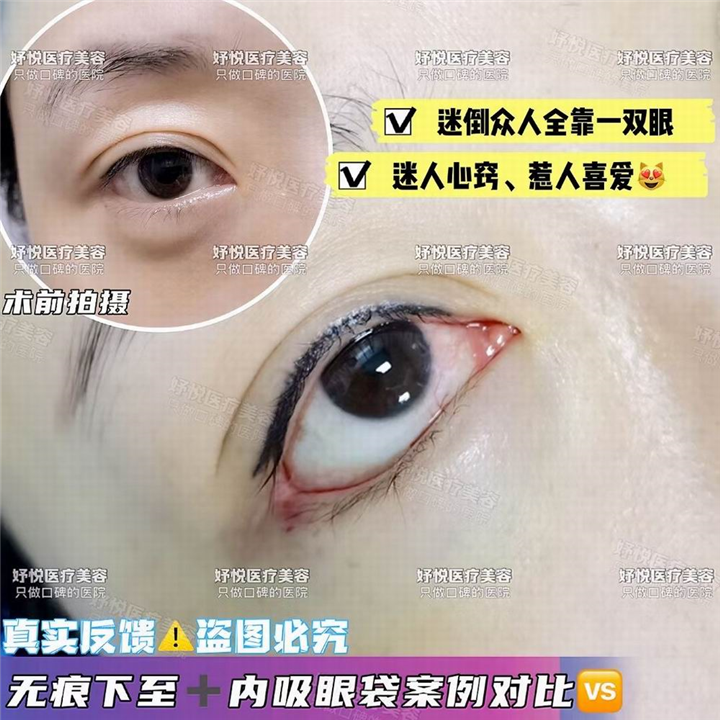 妤悦整形眼综合