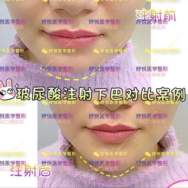 成都网红整形|成都鼻综合整形