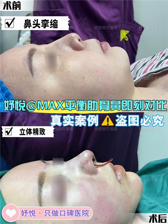 妤悦整形丰胸案例