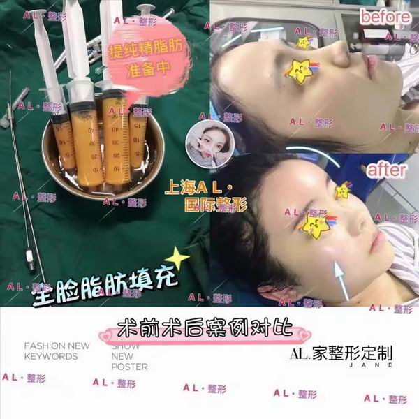 上海AL整形|上海AL鼻综合