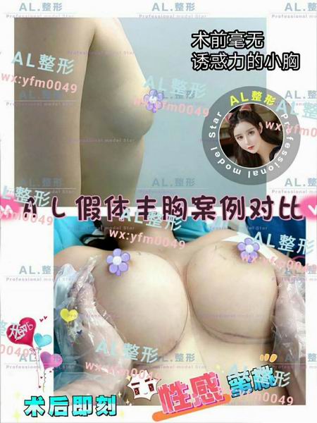 上海AL眼综合|上海AL脂肪填充