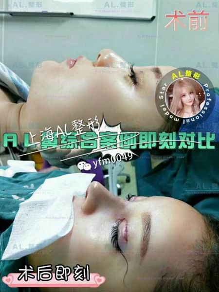上海AL整形|上海AL鼻综合