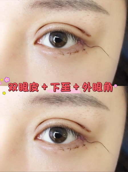 深圳软肋骨鼻综合|深圳眼综合整形