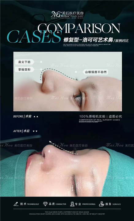 自体软骨隆鼻效果真的好吗？是自吹自擂吧！